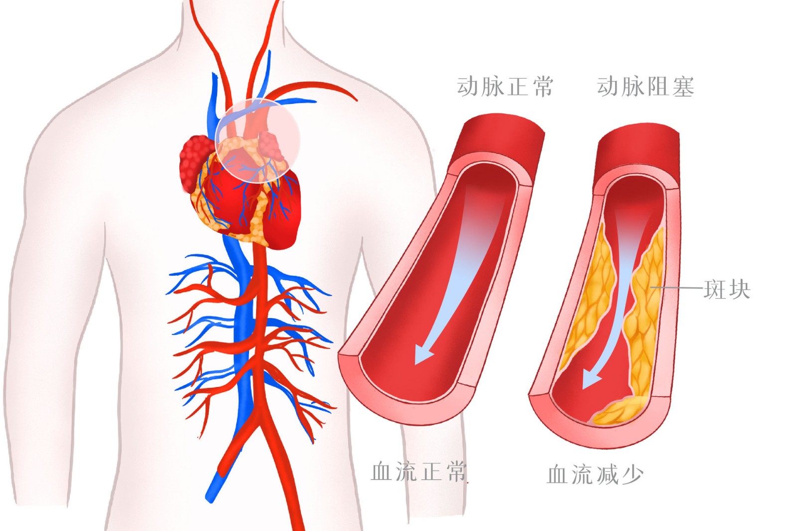 摄图网_401802186_高血压血管病变医疗插画(企业商用).jpg